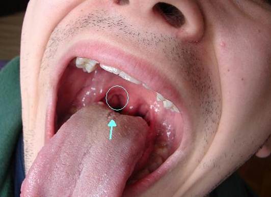 humani papiloma virus u ustima