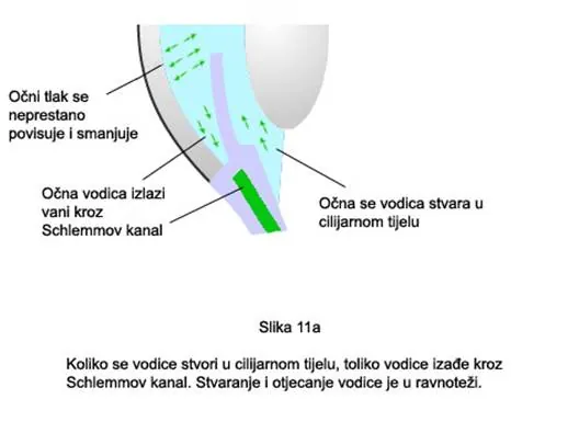 Glaukom – ilustracija 15