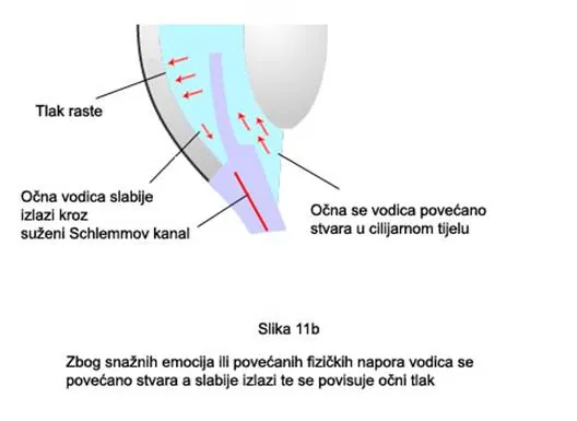Glaukom – ilustracija 16